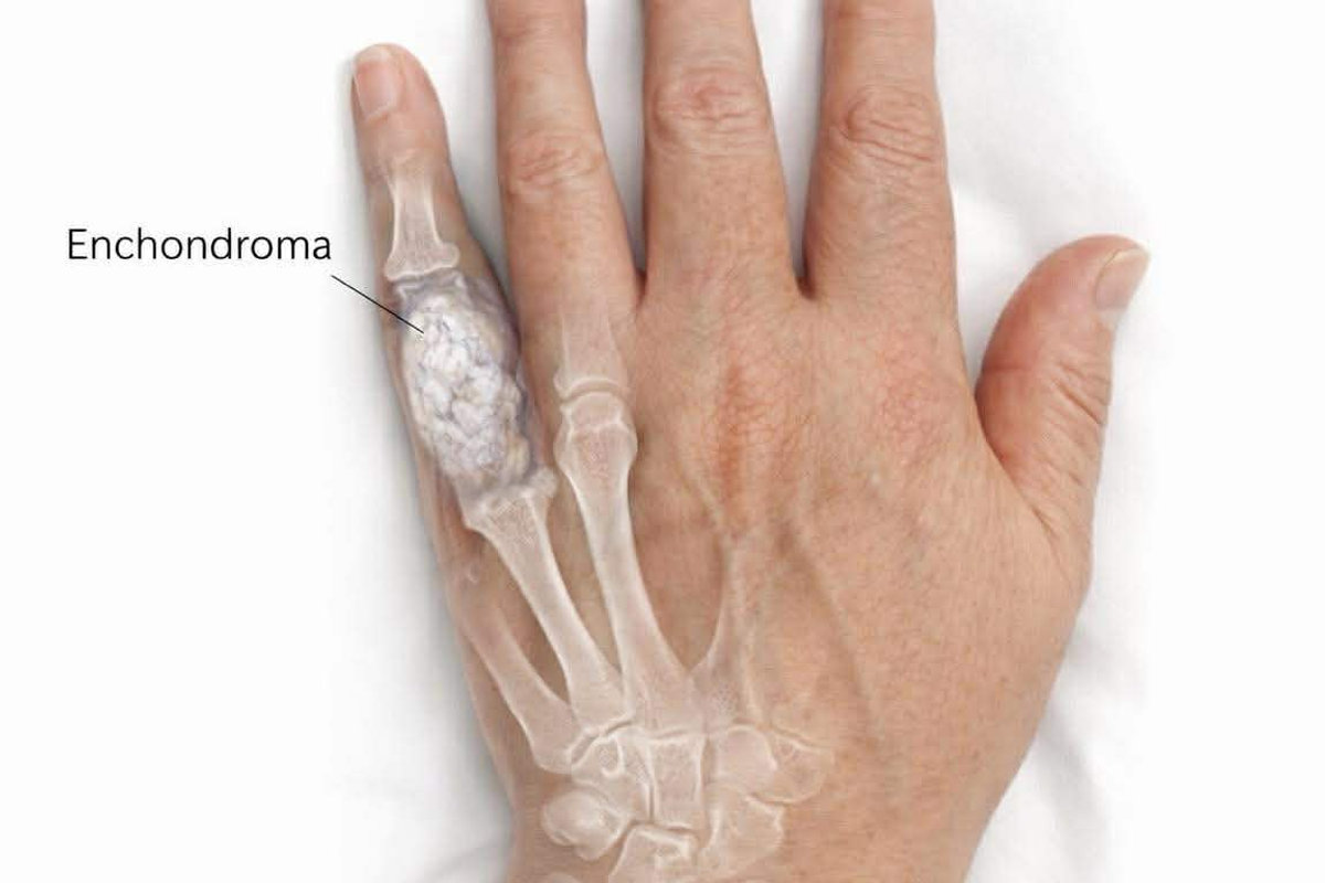 Enchondroma of the Hand: When a Bone Tumor Causes a Finger Fracture
