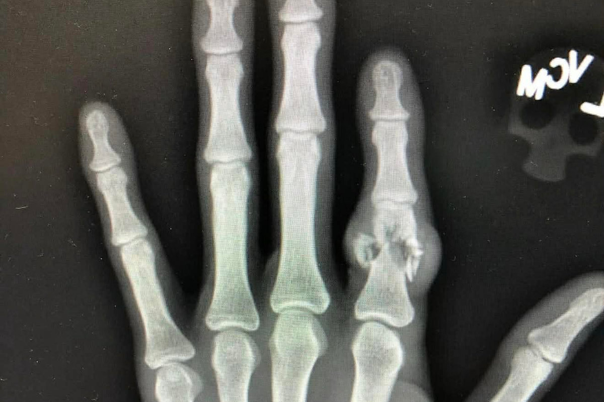 Finger Amputation: Replantation, Revision & What to Do When You’ve Lost a Finger