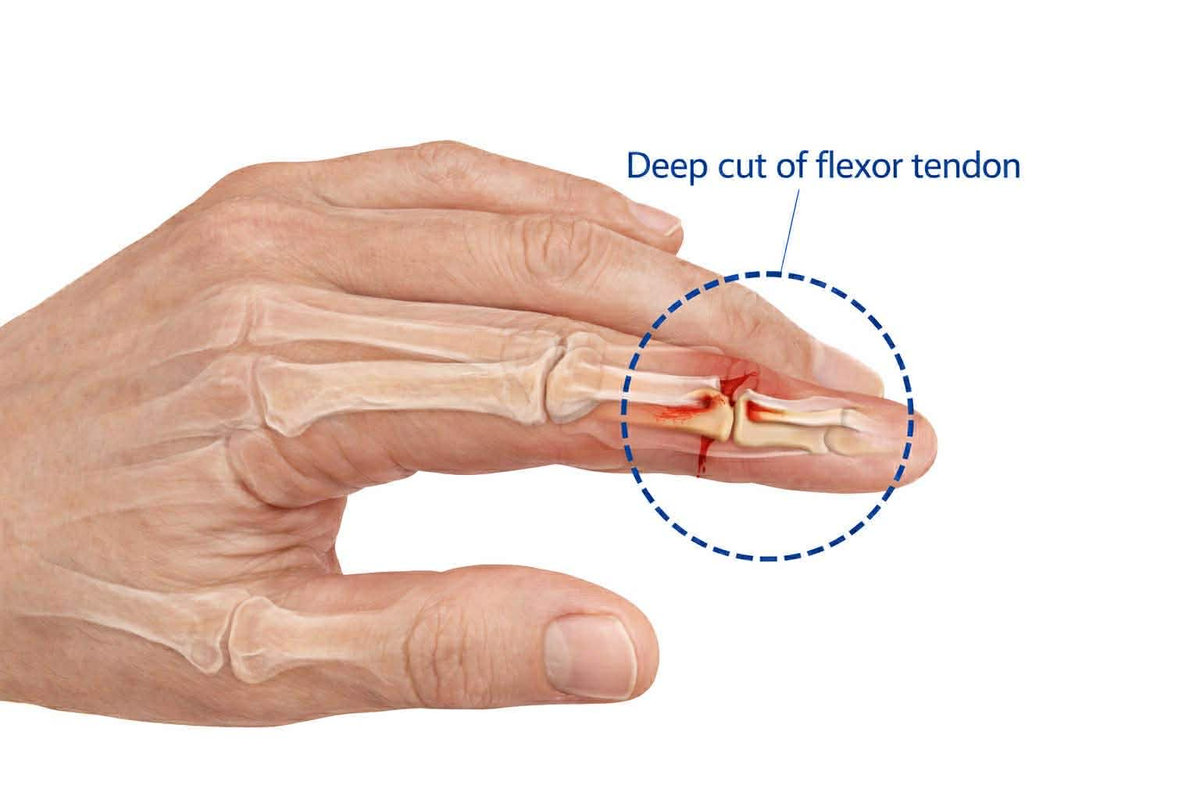 Cut Tendon in Your Hand? Why Flexor Tendon Repair Can’t Wait