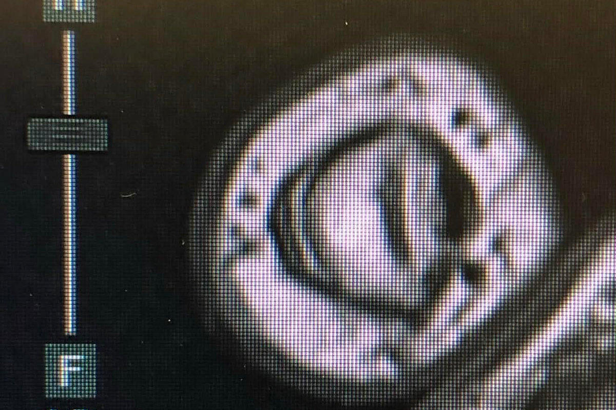 Glomus Tumor of the Finger: The Tiny Tumor That Causes Big Pain