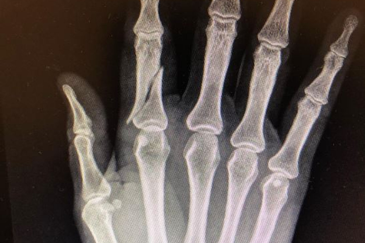 Broken Hand or Wrist? A Hand Surgeon’s Guide to Fracture Treatment in Phoenix