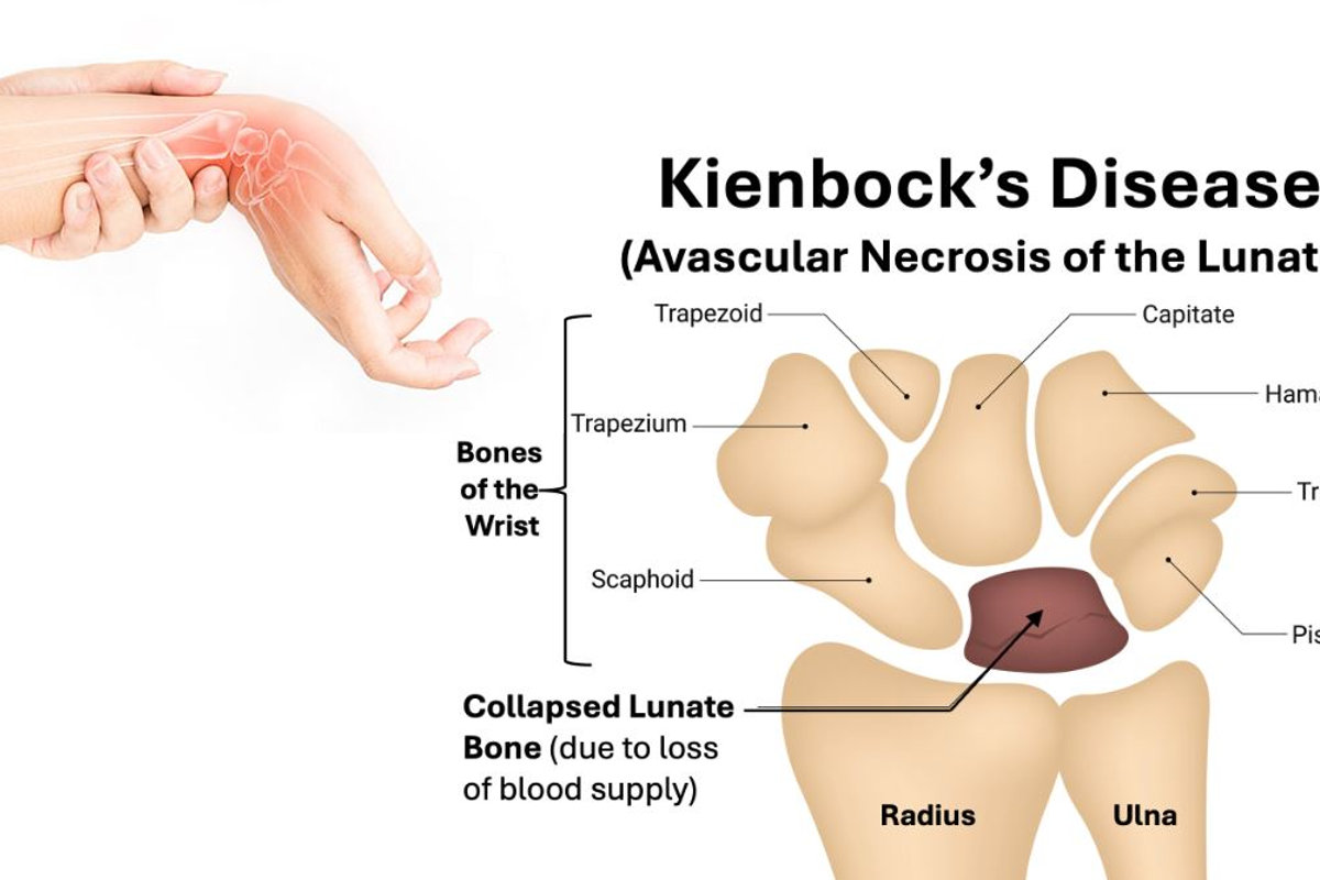 Kienböck’s Disease: When the Lunate Bone Dies (Causes, Staging & Treatment Options)