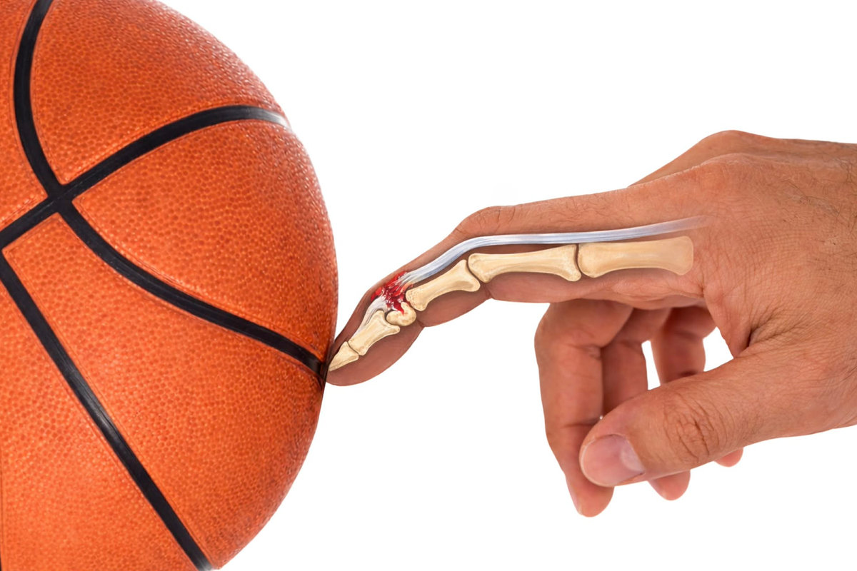 Mallet Finger: The Drooping Fingertip Injury (Causes, Splinting & Surgery in Phoenix)