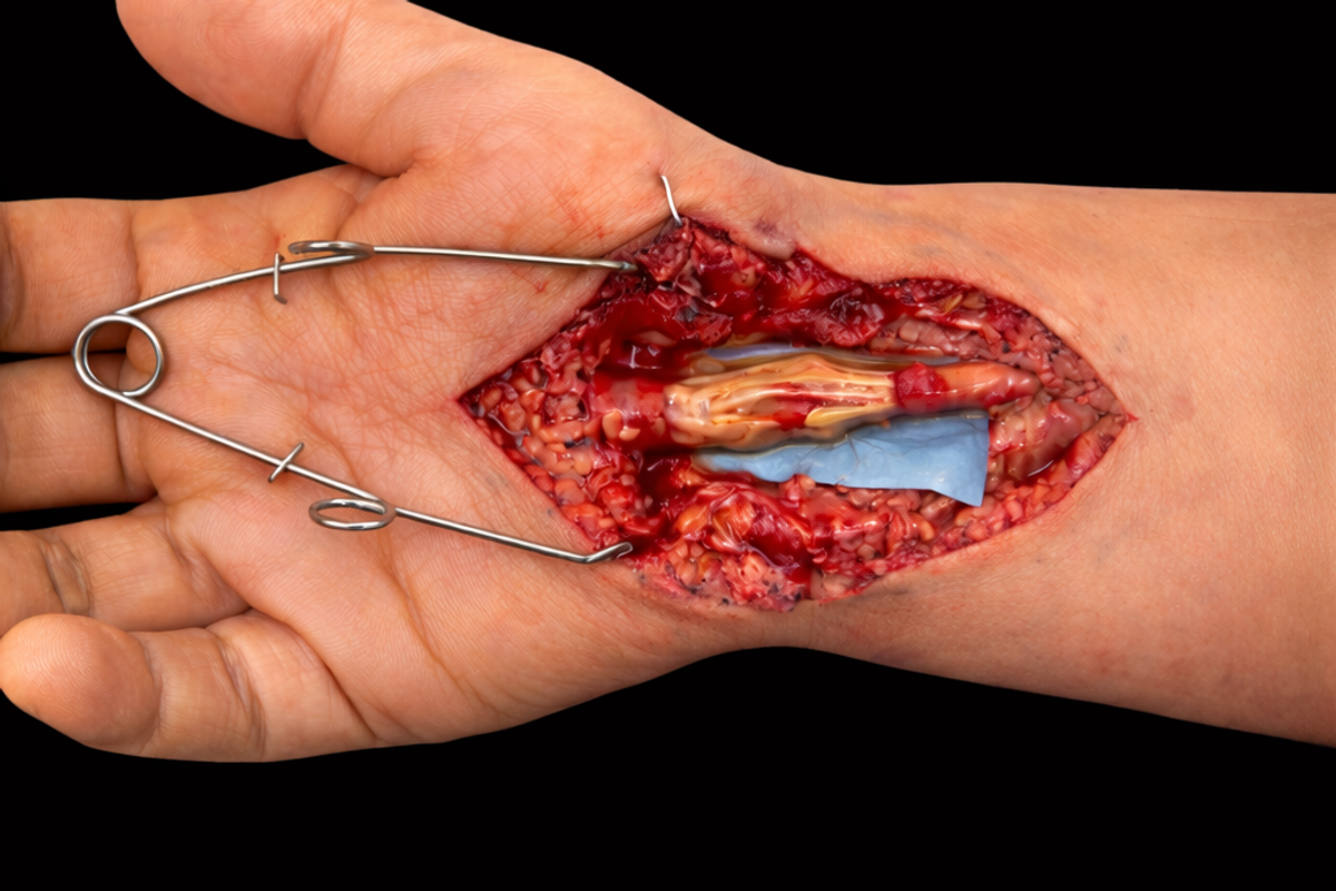Nerve Injury in the Hand or Wrist: Repair, Recovery & What a Phoenix Hand Surgeon Wants You to Know