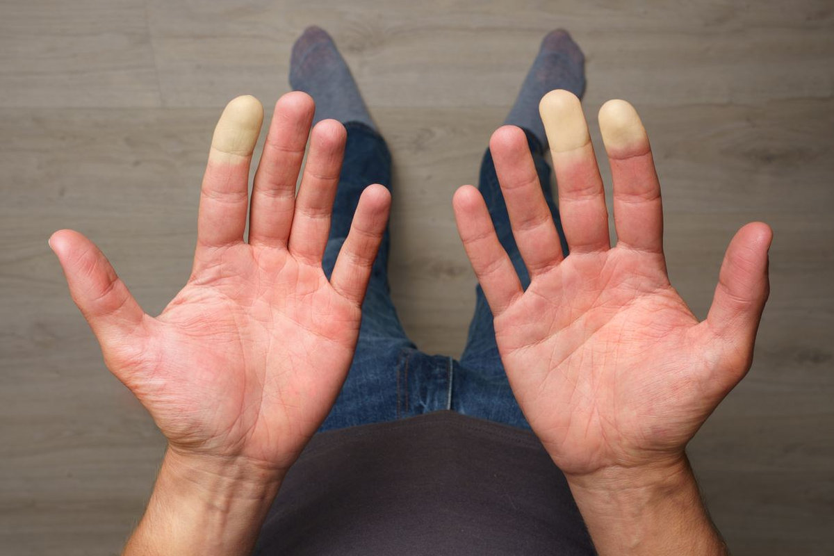 Raynaud's Disease: When Your Fingers Turn White