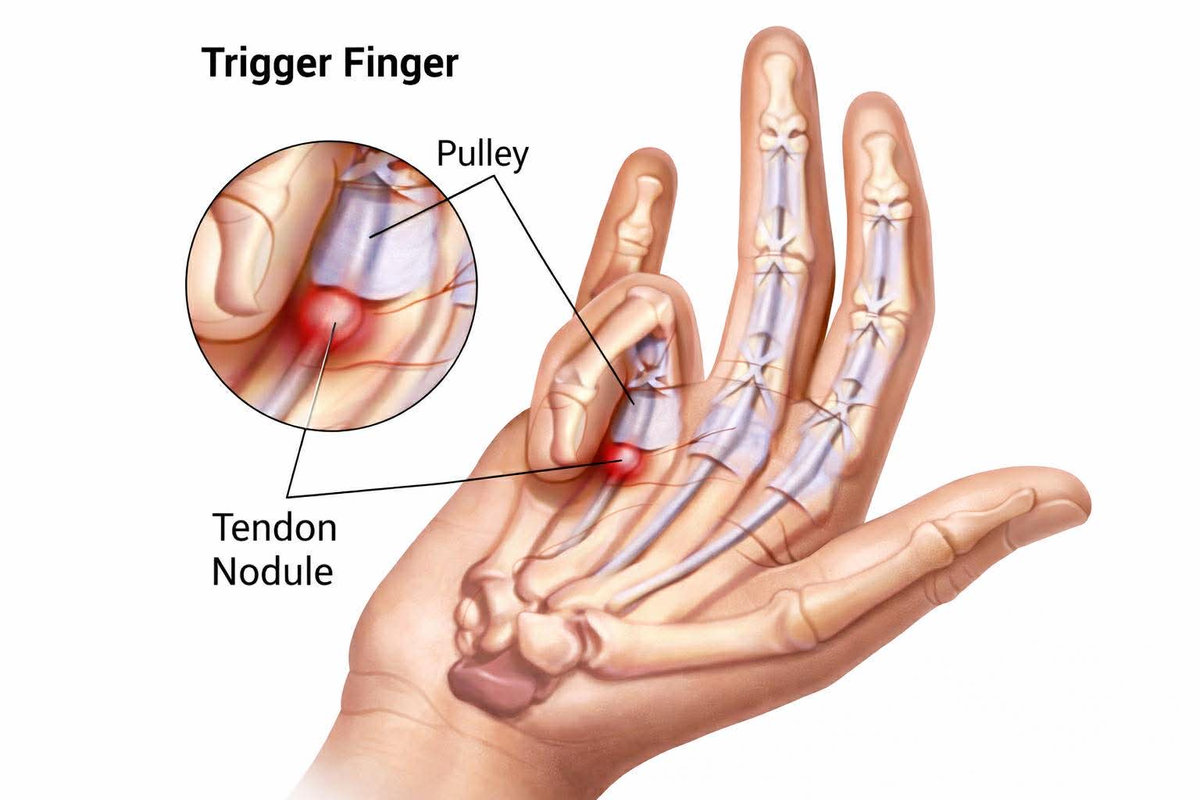 Trigger Finger Treatment in Scottsdale & the East Valley: When Do You Need Surgery?
